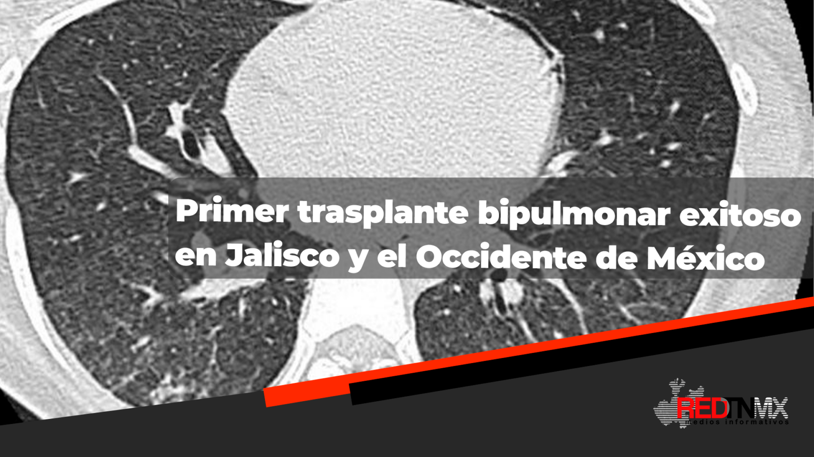 Ulises Josu Calvo Bravo El Primer Trasplante Bipulmonar Exitoso En