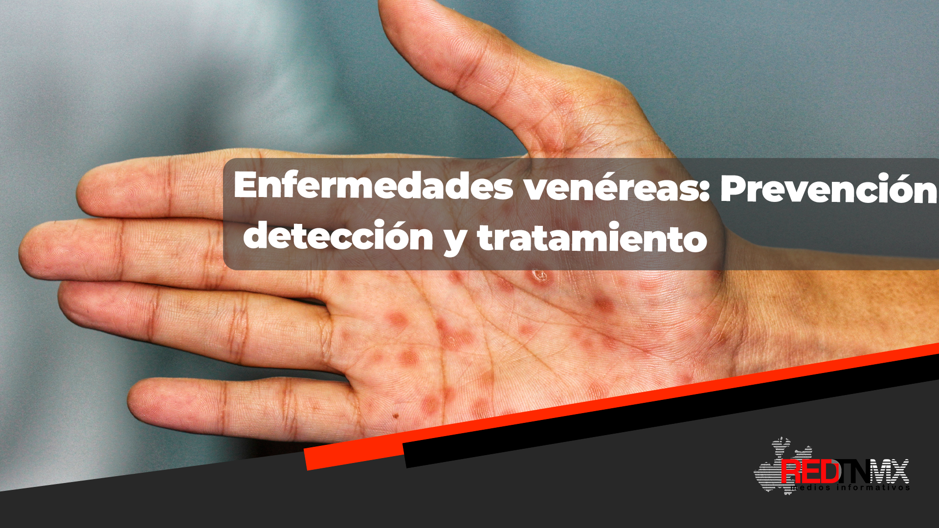 Enfermedades Venéreas: Prevención y Conciencia en la Salud Sexual